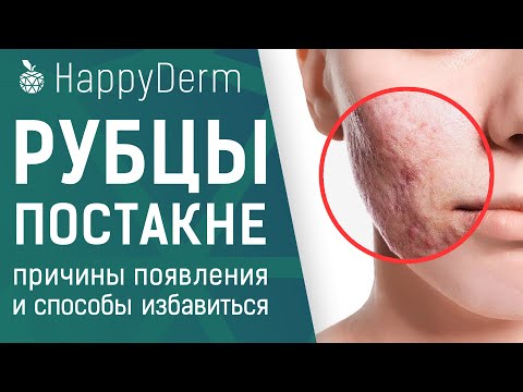 Липома — что это такое, опасен ли жировик на теле и как удалить липому (Копировать)