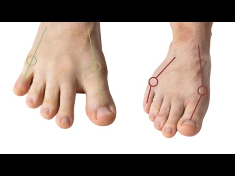 The basis of healthy walking: Learn to correctly position your foot