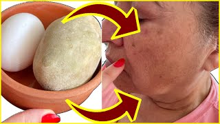 %💯 Etkili - Annem 60 Yaşında-Patates Maskesi İle Lekelerini Siliyoruz- Sarkmaları Toparlayan Maske