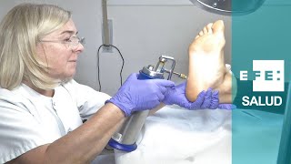 Crioterapia para curar verrugas plantares