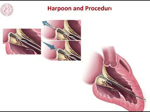 Gino Gerosa   Nuova tecnologia della riparazione mitralica transapicale