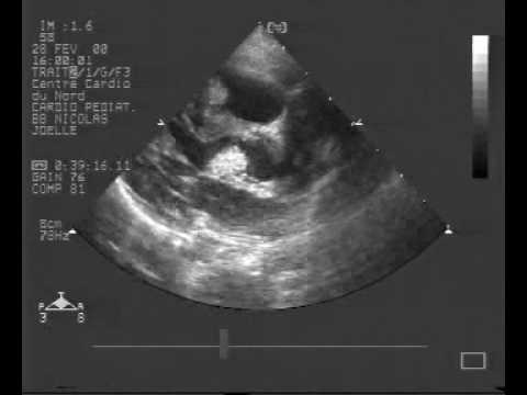 Mnogie mięśniaki prążkowanokomórkowe u niemowlęcia z choroba Bourneville'a - Pringle'a.