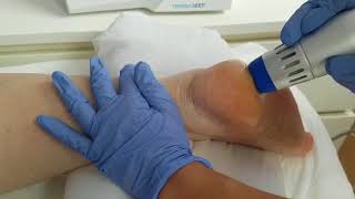Fascitis plantar y ondas de choque