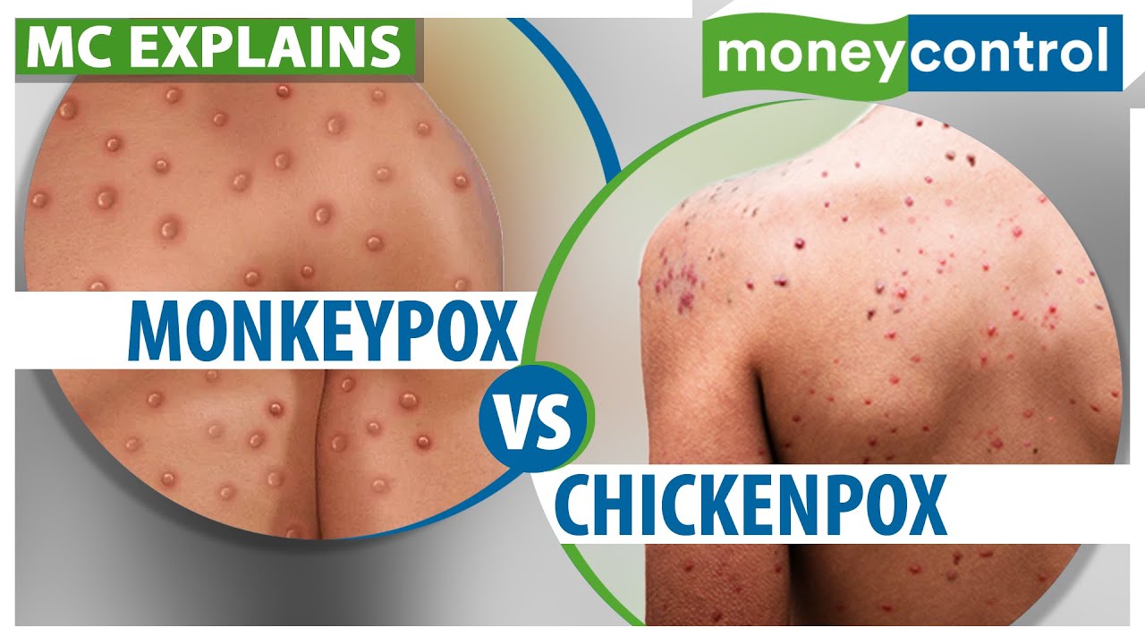Monkeypox: How Is It Different From Chickenpox | Explained