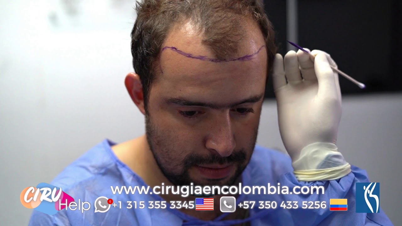 Watch CIRUGIA PARA LA CALVICIE / DR LUIS PAVAJEAU Now CIRUGIA PARA LA CALVICIE / DR LUIS PAVAJEAU