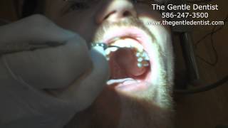 preview picture of video 'Shelby Township Dentist Repairs Broken Front Teeth'