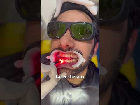 Laser treatment for bleeding gums #newmusic #dental #tech #laser #digital #whitening #cosmetic #gym
