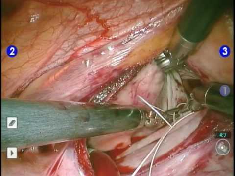 Robotic Assisted Beating Heart Mitral Valve Repair