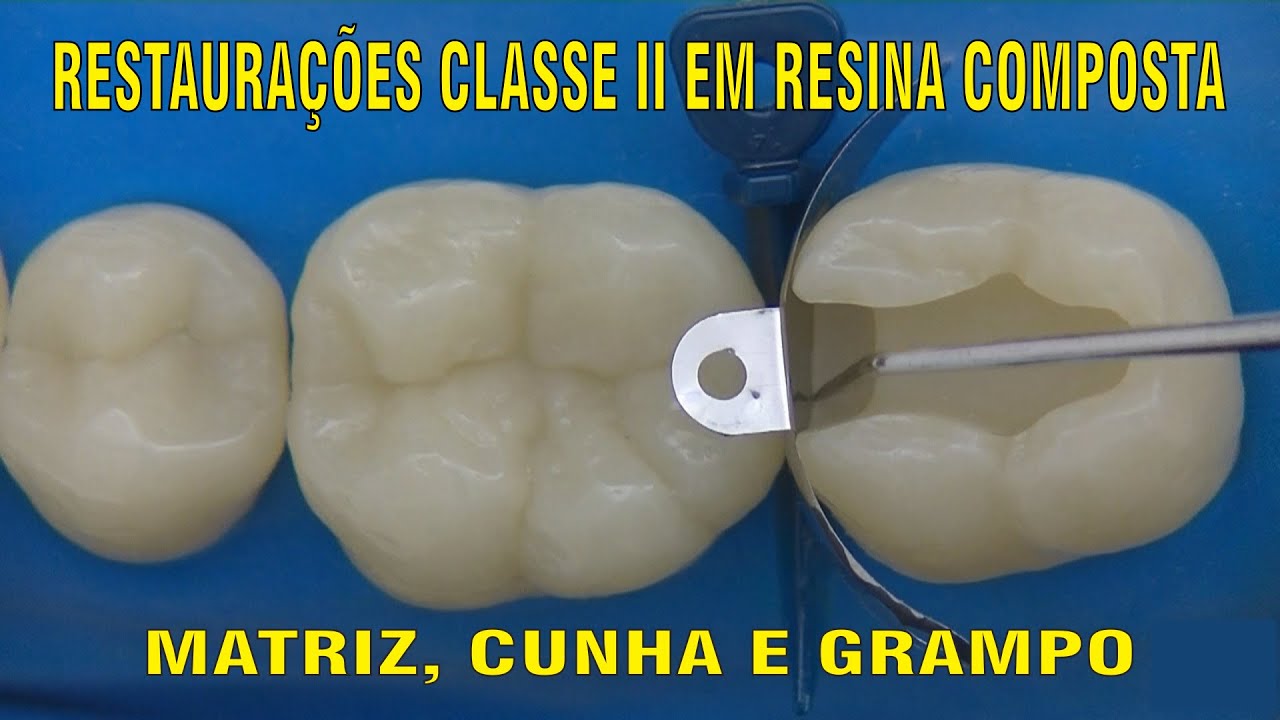 Restauração Classe II em Resina Composta - PARTE 1