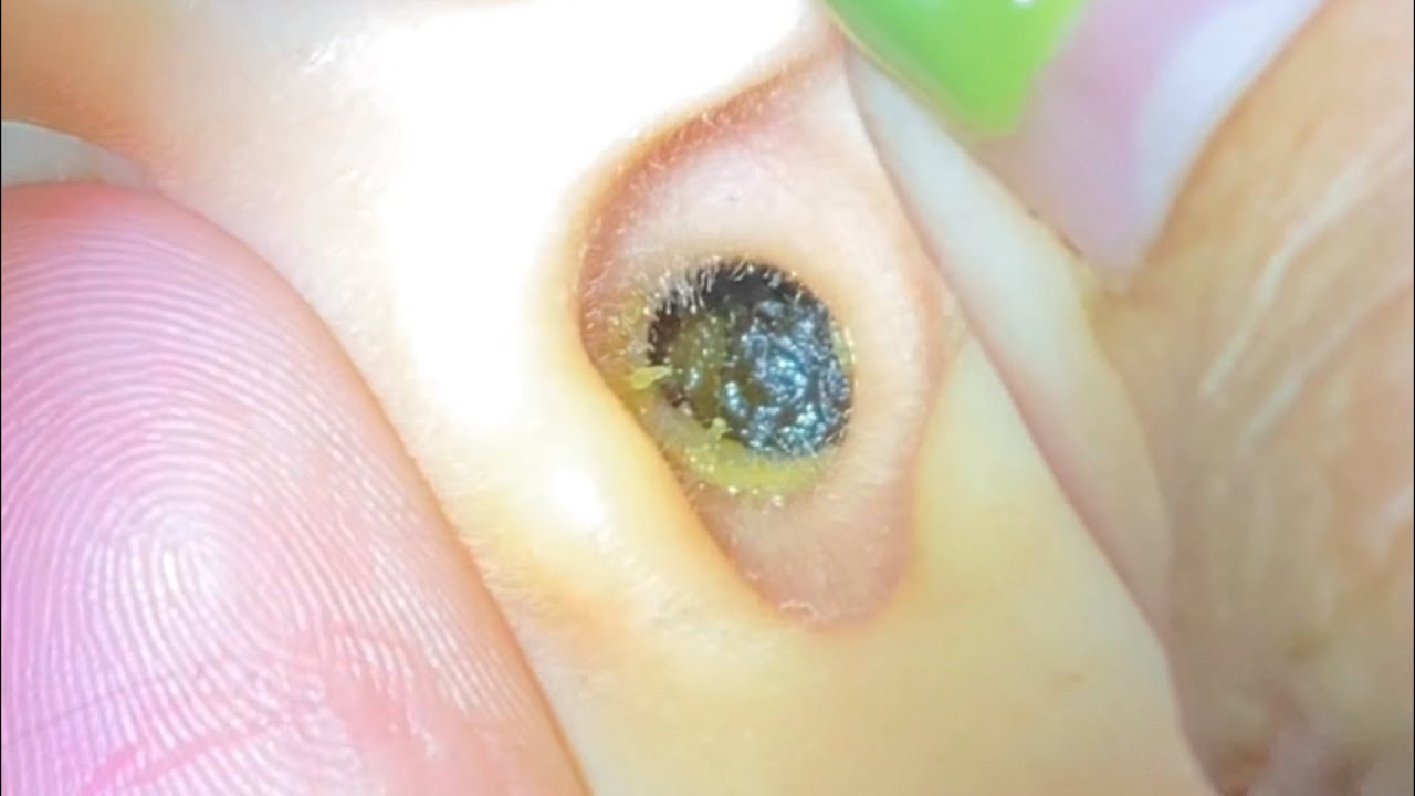 ASMR耳掃除: 黒くて固まった耳垢を全部取り除く！