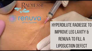 Hyperdilute Radiesse To Improve Leg Laxity & Renuva To Fill A Liposuction Defect