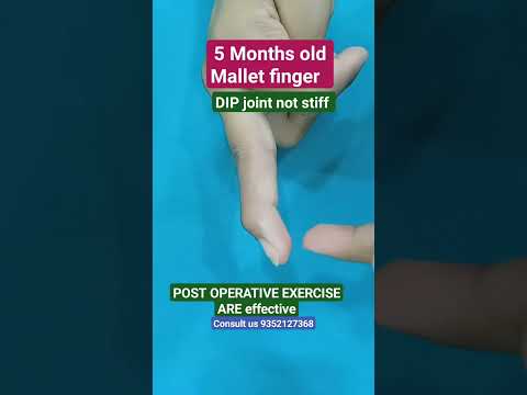 Mallet finger #hand #physiotherapy #movement #advice #pain #finger #stiffness #thumb #bpi #mnd #old