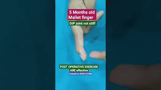 Download lagu Mallet finger #hand #physiotherapy #movement #advice #pain #finger #stiffness #thumb #bpi #mnd #old mp3