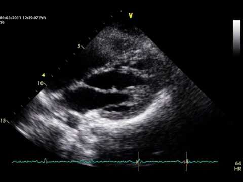 Muscular Band In the Left Ventricle