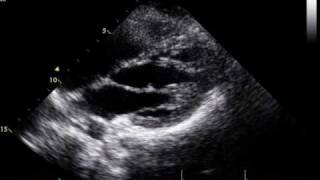 preview picture of video 'muscular band in the left ventricle.'