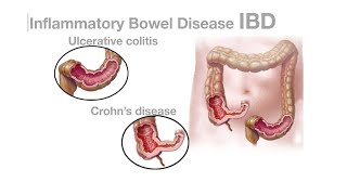 Mayo Clinic Minute: Can diet help with inflammatory bowel disease?