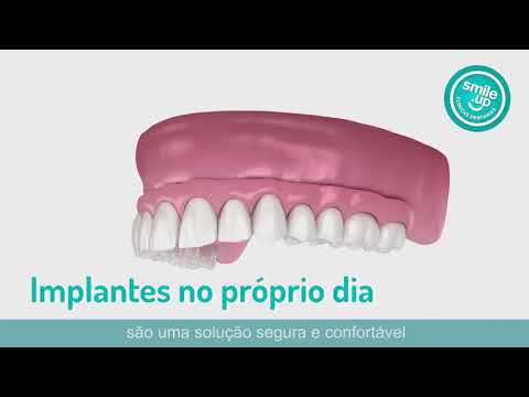 Implantes Dentários no Próprio Dia