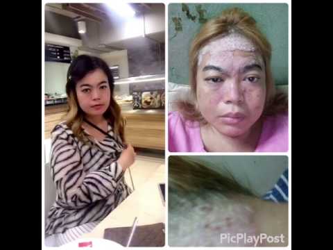 ครีมหรือครีมจาก neurodermatitis วางโดดเด่นโรคสะเก็ดเงิน