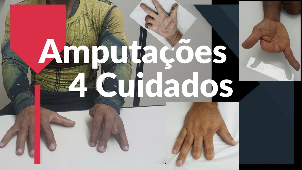 Amputação, Recuperação e Próteses