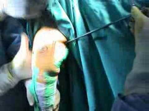 Arthroscopic Elbow Insertion Of Anteromedial Portal