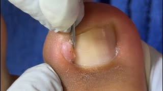 Ep_8836 Ingrown toenail removal 👣 เล็บไม่เคยพ้นขอบครับ..ผมจะตัดก่อน 😅 (clip from Thailand)