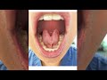 Tongue Tie: Severity Grades 1-4 (Tongue Range of Motion Ratio)