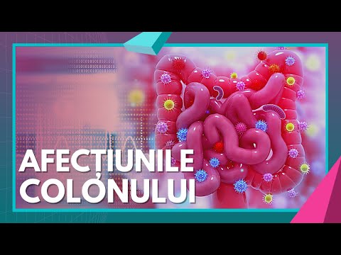 COLON Cancer | Symptoms, Causes, Investigations | Health with Priority