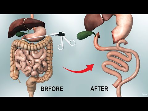 Gastric Bypass Y Surgery - Roux en Y 2022 3D Animation