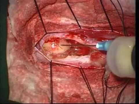 Interspinal Teratoma Of The Loins With Blocked Cord