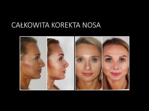 MEA CLINIC - Przed i po operacji nosa (efekty zabiegów)