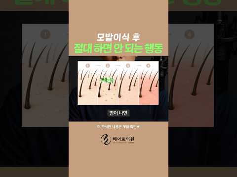 모발이식 후 운동하면 생착률 떨어질까?ㅣ헤어로의원 전주점ㅣ