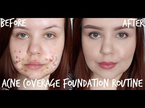 Acne Coverage Foundation Routine | Full Coverage for Cystic Acne/Scarring Video
