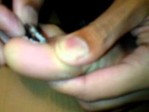 Fluconazole halamang-singaw kuko Kapag kuko halamang-singaw kapag kumukuha tablets