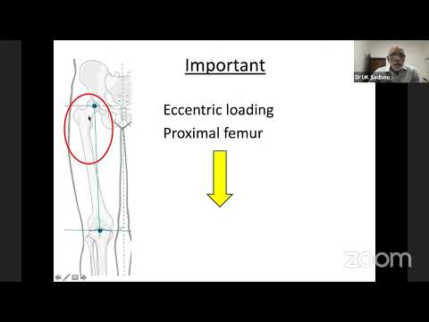 OREF India Web class for Orthopaedic Postgraduates: Subtrochanteric Femur Fracture