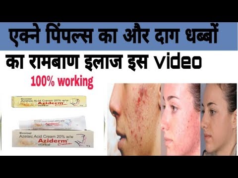 azelaic aziderm pigmentation pimples