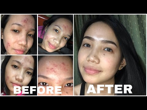 17 taong gulang tao mawalan ng timbang Kung gaano kabilis mawala ang bigat para sa cesarean seksyon