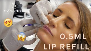 0.5ML LIP REFILL | NATURAL LOOKING FULL LIPS | LIP FILLERS | VIVA Skin Clinics