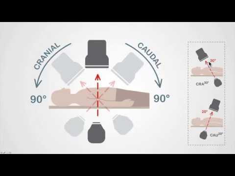 Coronary Angiography - Image Intensifier Basics And Nomenclature