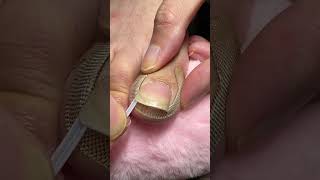 Download lagu ✅ Effective toenail care for foot pain ( # 2553 ) - Toe Nail Support Pad mp3