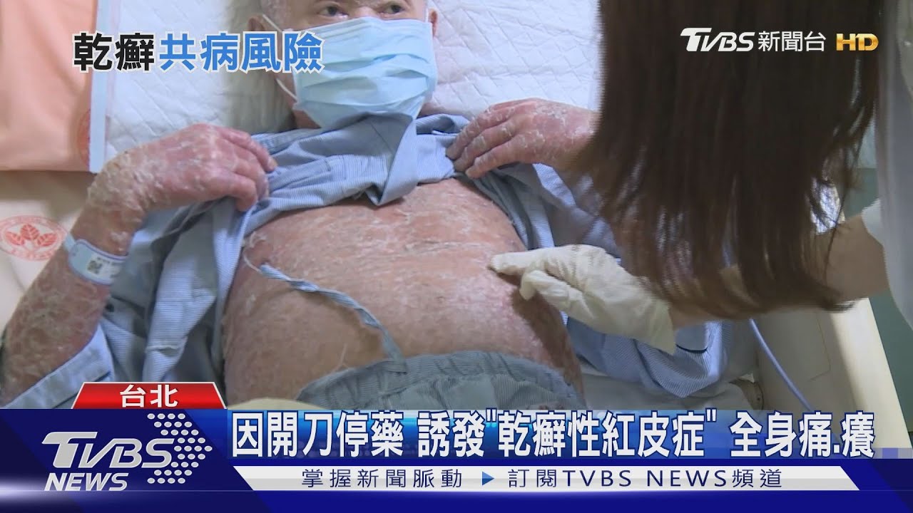 別以為「乾癬」只是皮膚病 會引起「全身性發炎」這些器官恐嚴重受損!
