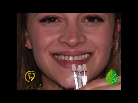 Porcelain veneers (Digital approach) تجميل الاسنان باستخدام الحديث في طب الاسنان الرقمي