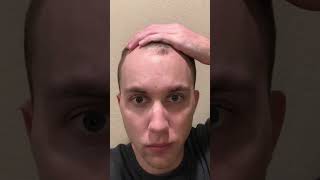 Hair Loss and its effects on Mental Health #health #hairloss #menshair