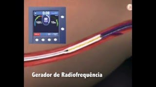 Tratamento de Varizes por Laser