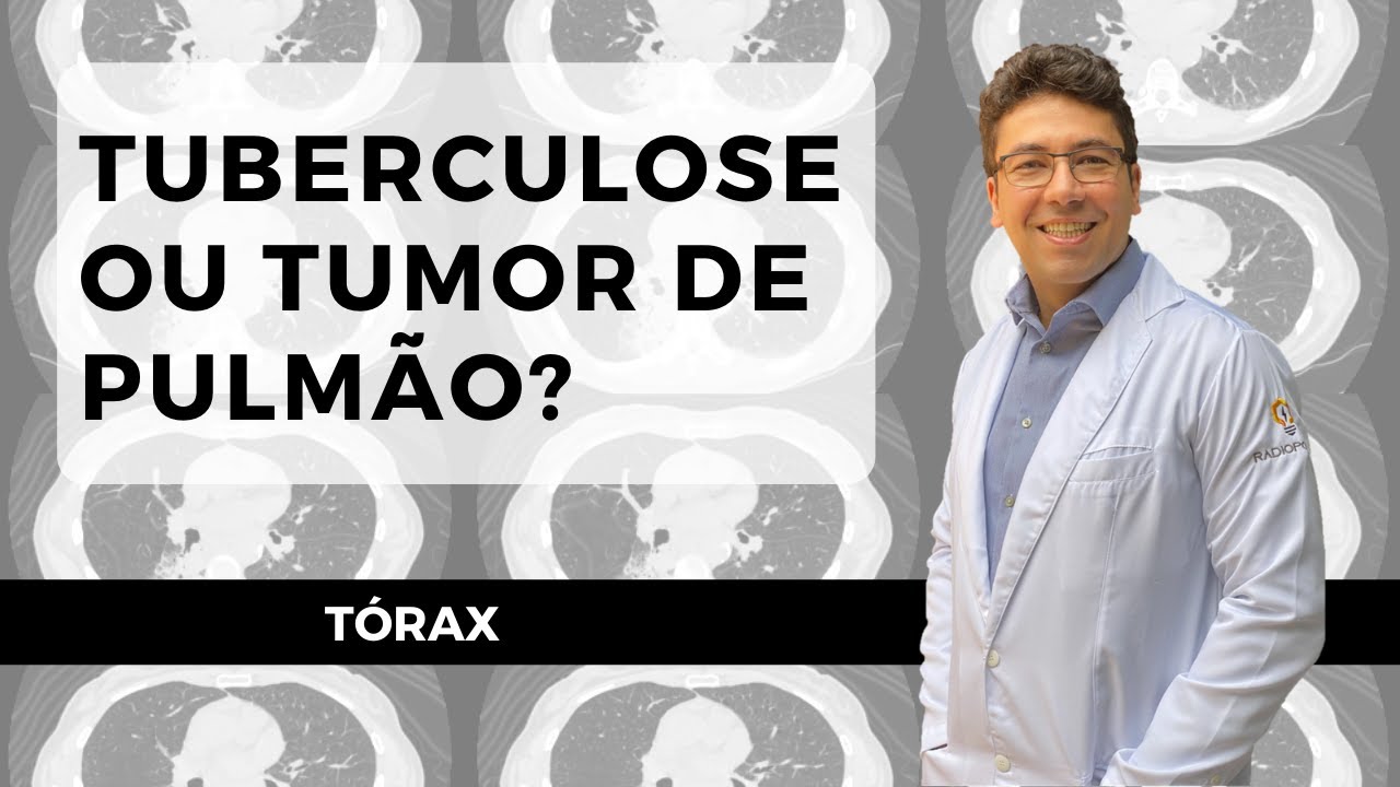 TUBERCULOSE OU TUMOR DE PULMÃO?
