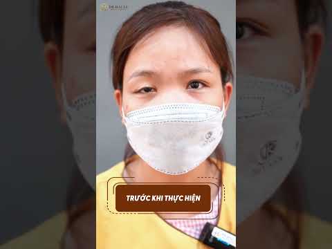 Tự Ti Vì Sụp Mí Bẩm Sinh Trải Qua Nhiều Năm Khó Khăn?
