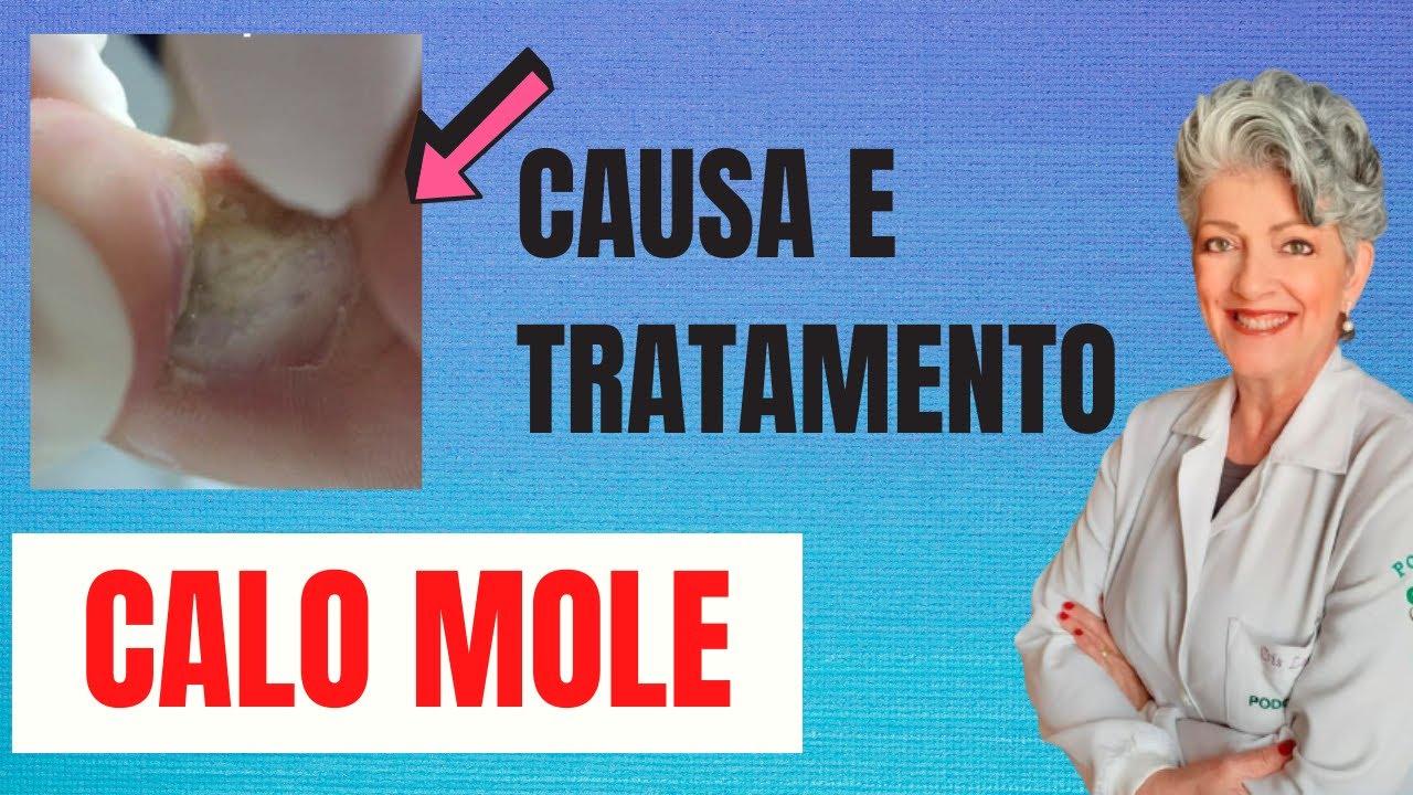 CALO MOLE ENTRE OS DEDOS | Saiba o que é e Como tratar