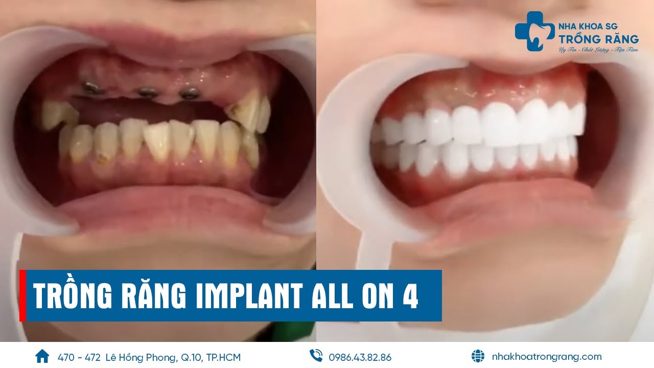 Trồng răng implant all on 4 | dental implants