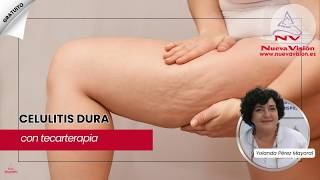 Celulitis Dura: Protocolo Corporal de Impacto: Tecarterapia + Mesoterapia Virtual