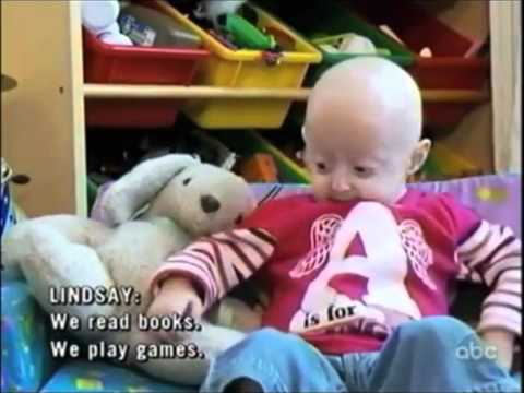 Progeria