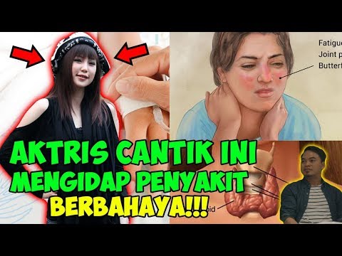 gampang-stres-bisa-terserang-penyakit-autoimun-ngaso-w-aelke-mariska